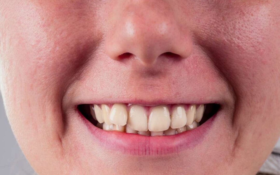 Invisalign vs Braces: Which Is Better?