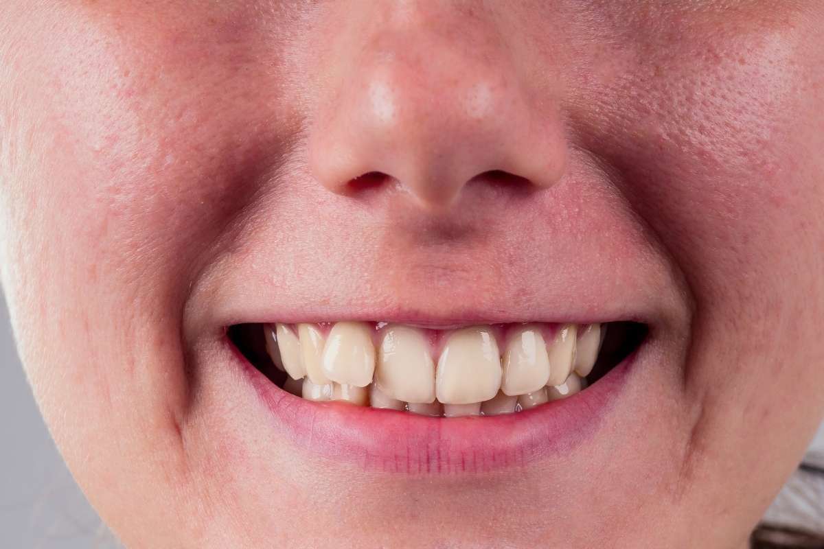Invisalign vs Braces Which Is Better Patient displaying a bright, straight smile with properly aligned teeth after orthodontic treatment.