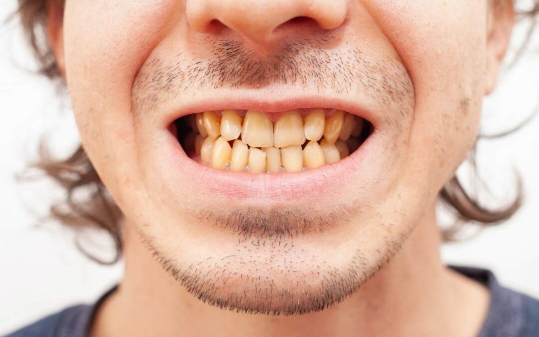 Veneers vs Teeth Whitening: Which One Do You Need?