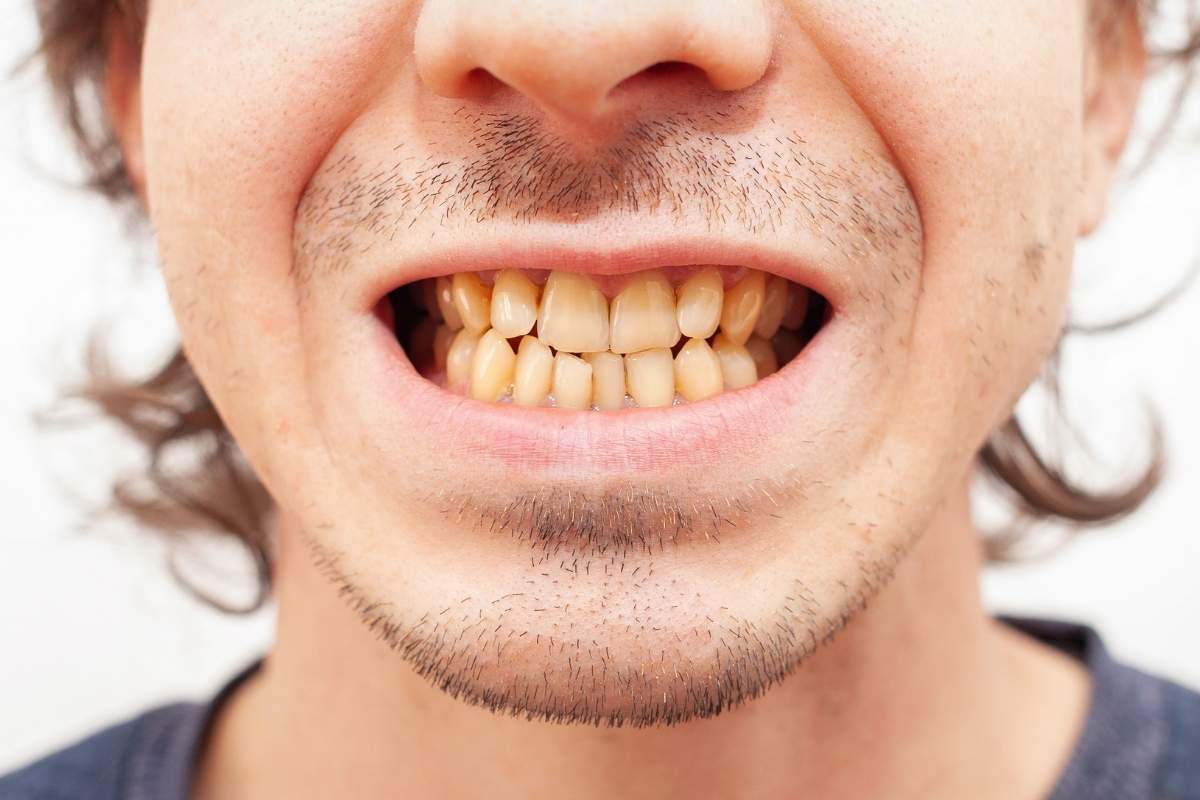 yellow teeth Man with discolored and misaligned teeth displaying need for cosmetic dental treatment options.