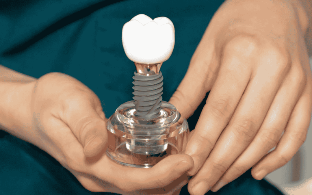 Can You Get Dental Implants Years After Losing a Tooth?